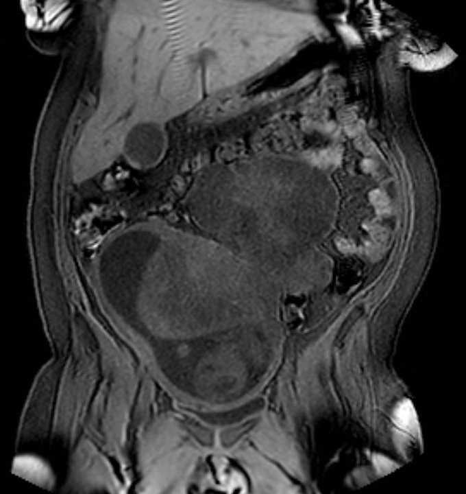 Colon adenocarcinoma with Krukenberg tumors, advanced pregnancy (Radiopaedia 67279-76645 E 31).jpg