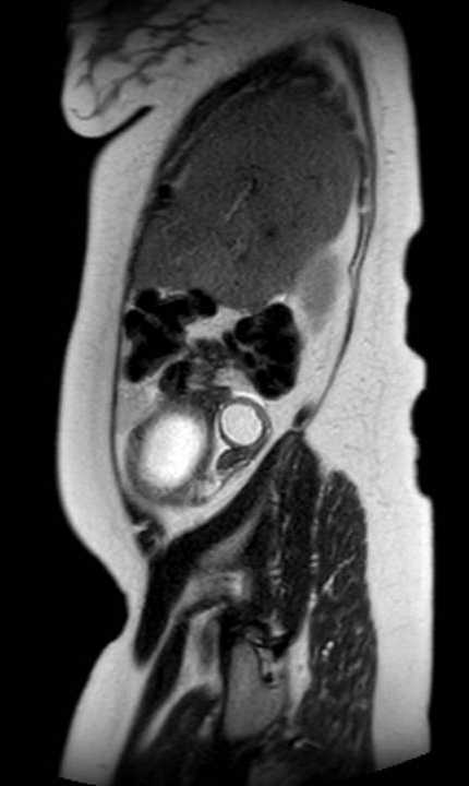 Colon adenocarcinoma with Krukenberg tumors, advanced pregnancy (Radiopaedia 67279-76645 Sagittal T2 42).jpg
