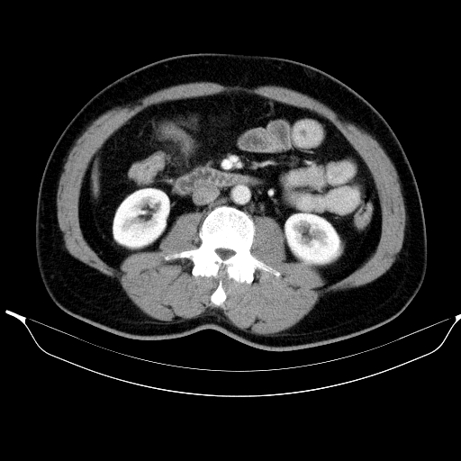 Colonic lipoma with colo-colic intussusception (Radiopaedia 58944-66200 A 31).jpg