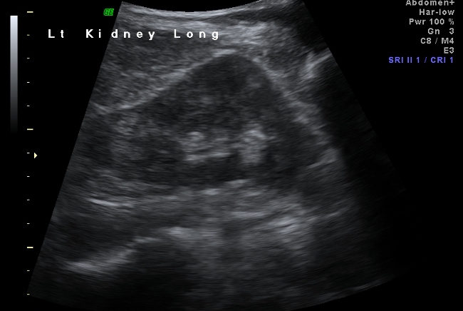 File:Dromedary hump of the left kidney (Radiopaedia 53697).jpg