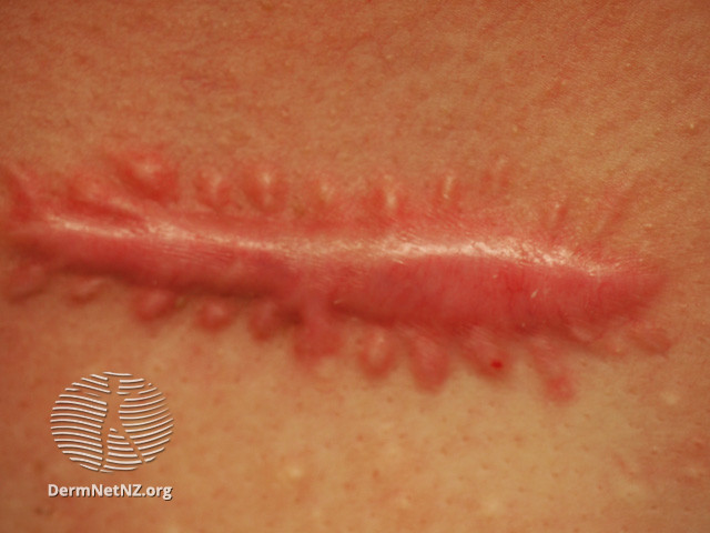 File:Keloid scar (DermNet NZ dermal-infiltrative-keloid22).jpg