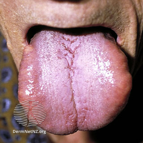 File:Macroglossia due to systemic amyloidosis (DermNet NZ systemic-s-amyloid9).jpg