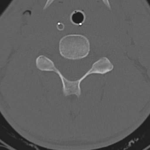 File:Multitrauma with diffuse axonal injury, temporal bone fractures and traumatic caroticocavernous fistula (Radiopaedia 37242-39035 Axial 175).png