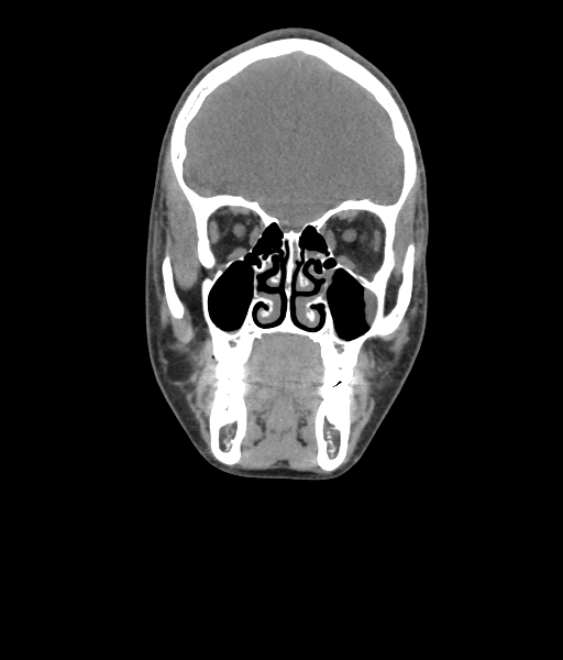 Nasal pyogenic granuloma (lobular capillary hemangioma) (Radiopaedia 85536-101244 Coronal non-contrast 85).jpg