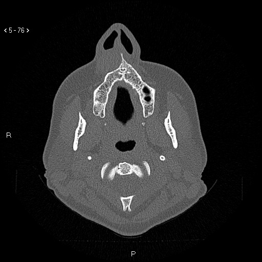 Nasolabial cyst (Radiopaedia 75125-86194 Axial bone window 37).jpg