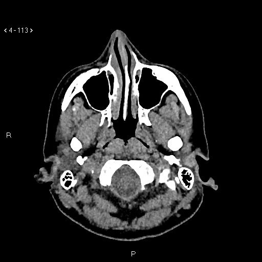 Nasolabial cyst (Radiopaedia 75125-86194 Axial non-contrast 75).jpg