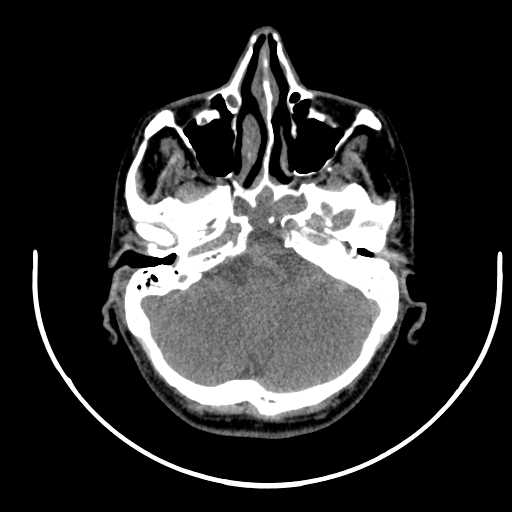 File:Nasopharyngeal carcinoma - infiltrating the clivus (Radiopaedia 62583-70875 Axial non-contrast 10).jpg