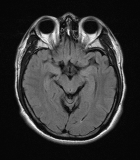 File:Nasopharyngeal carcinoma with pterygopalatine fossa involvement (Radiopaedia 33102-34134 Axial FLAIR 10).png