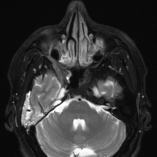 File:Nasopharyngeal carcinoma with pterygopalatine fossa involvement (Radiopaedia 33102-34134 Axial T2 21).png
