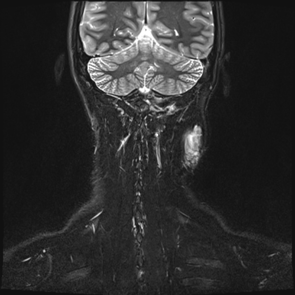 Nasopharyngeal carcinoma with skull base invasion (Radiopaedia 53415-59485 Coronal T2 fat sat 2).jpg