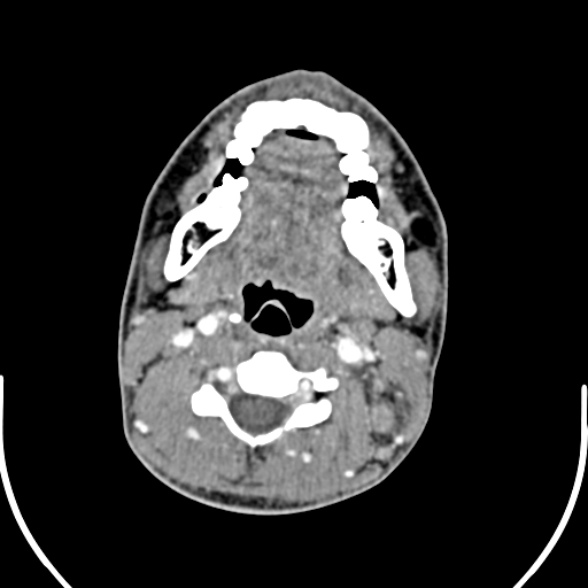 File:Nasopharyngeal carcinoma with skull base invasion (Radiopaedia 53415-59705 A 109).jpg