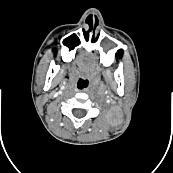 File:Nasopharyngeal carcinoma with skull base invasion (Radiopaedia 53415-59705 A 80).jpg