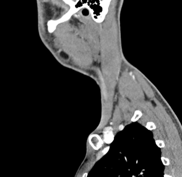Nasopharyngeal carcinoma with skull base invasion (Radiopaedia 53415-59705 C 8).jpg