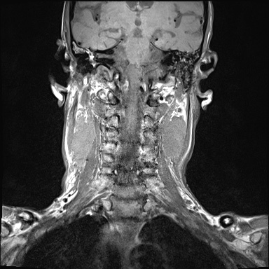 File:Nasopharyngeal carcinoma with skull base invasion (Radiopaedia 59258-66600 Coronal T1 10).jpg
