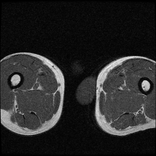 File:Necrotizing epididymo-orchitis with intra-testicular abscess (Radiopaedia 29397-29860 Axial T1 18).jpg