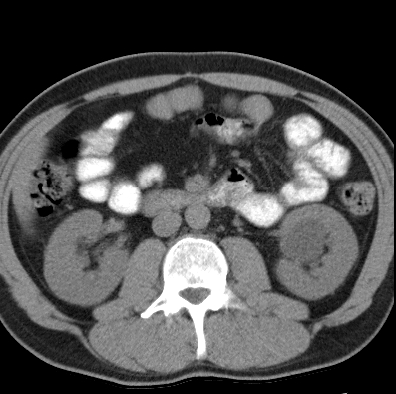 File:Necrotizing pancreatitis with acute necrotic collection (Radiopaedia 14470-14417 Axial non-contrast 23).jpg