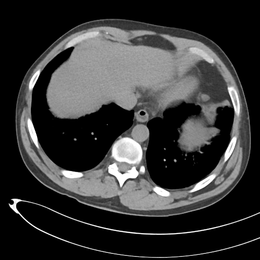File:Necrotizing pancreatitis with acute necrotic collections (Radiopaedia 38829-41012 Axial non-contrast 10).png