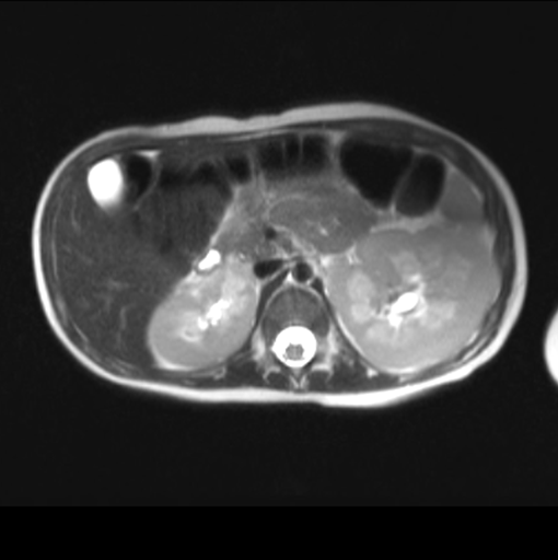 File:Nephroblastomatosis (Radiopaedia 39984-42477 Axial T2 1).png