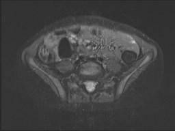 File:Neuroblastoma with bone metastases (Radiopaedia 67080-76414 Axial STIR 61).jpg