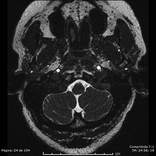Neurocysticercosis (Radiopaedia 58636-65832 I 24).jpg
