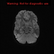 File:Neurofibromatosis type 1 with optic nerve glioma (Radiopaedia 16288-15965 Axial DWI 38).jpg