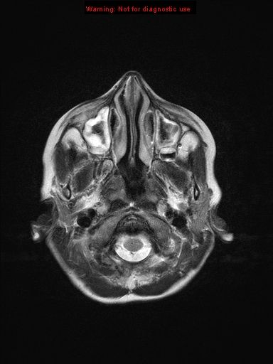 File:Neurofibromatosis type 1 with optic nerve glioma (Radiopaedia 16288-15965 Axial T2 23).jpg