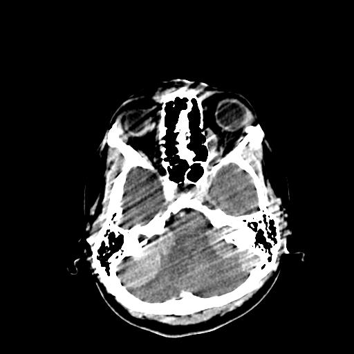 File:Neurofibromatosis type 2 (Radiopaedia 25389-25637 Axial C+ 16).jpg