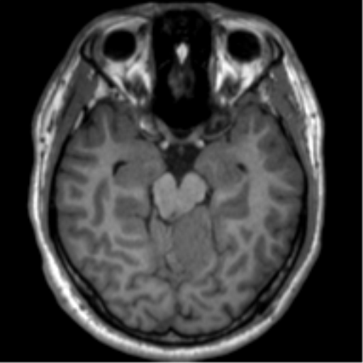 File:Neurofibromatosis type 2 (Radiopaedia 44936-48838 Axial T1 51).png