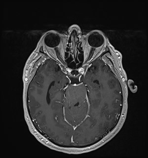 Neurofibromatosis type 2 (Radiopaedia 79097-92049 Axial T1 C+ 80).jpg