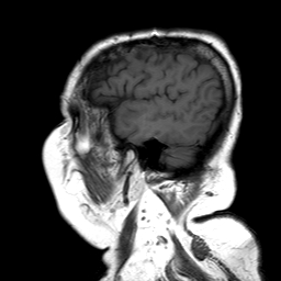 File:Neurofibromatosis type 2 (Radiopaedia 8713-9518 Sagittal T1 3).jpg