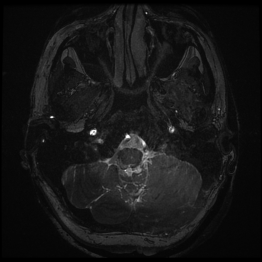 File:Neurofibromatosis type 2 - bilateral acoustic neuromata (Radiopaedia 40060-42566 Axial FIESTA 8).png