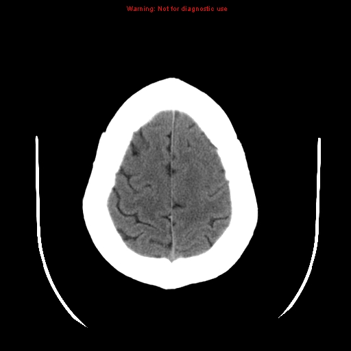File:Neuroglial cyst (Radiopaedia 10713-11185 Axial non-contrast 6).jpg