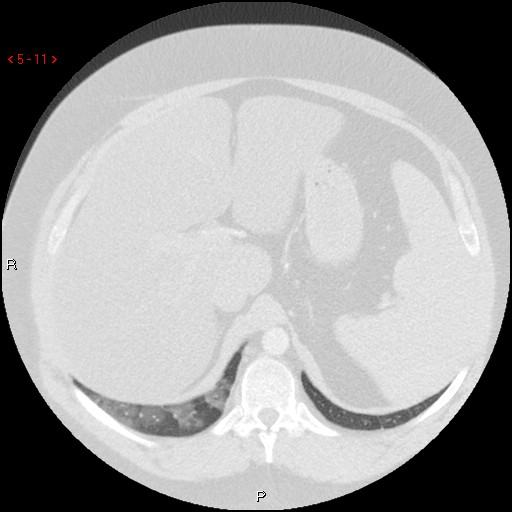 File:Non-specific interstitial pneumonitis (Radiopaedia 27044-27222 Axial lung window 2).jpg