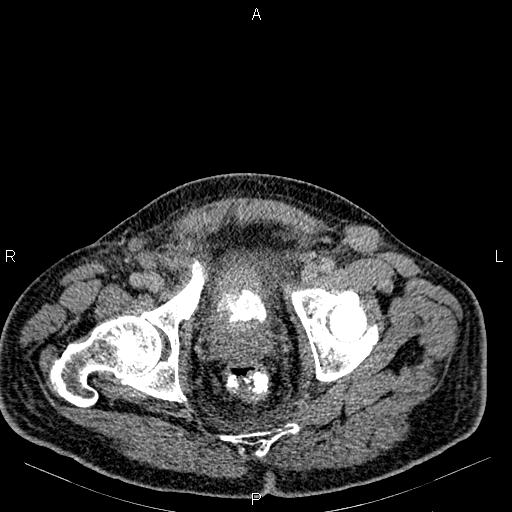 Non Hodgkin lymphoma in a patient with ankylosing spondylitis (Radiopaedia 84323-99621 Axial C+ delayed 77).jpg