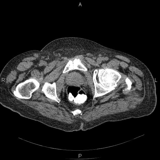 File:Non Hodgkin lymphoma in a patient with ankylosing spondylitis (Radiopaedia 84323-99624 Axial non-contrast 65).jpg