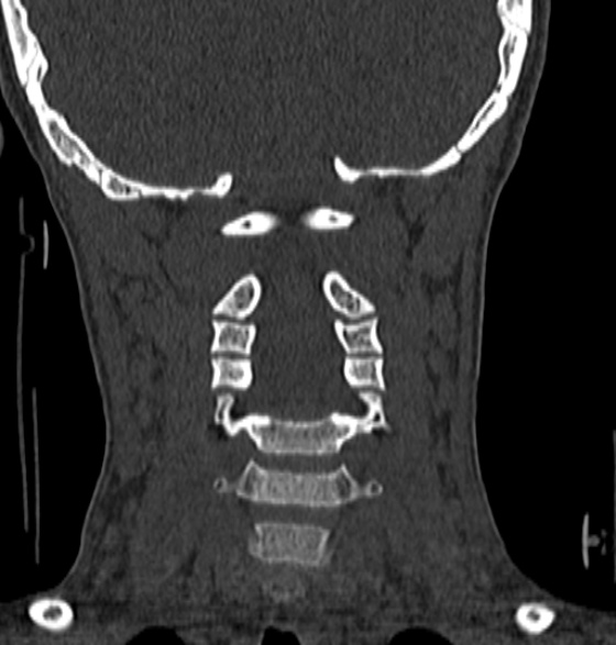 File:Normal CT cervical spine - 12-year-old (Radiopaedia 55352-61775 Coronal bone window 118).jpg