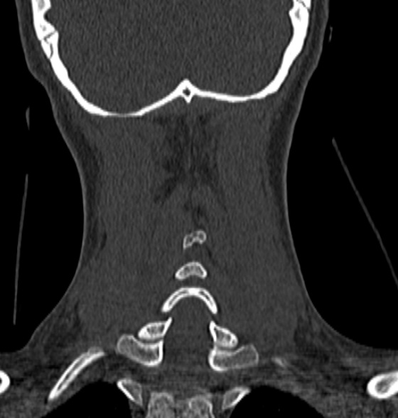 File:Normal CT cervical spine - 12-year-old (Radiopaedia 55352-61775 Coronal bone window 178).jpg