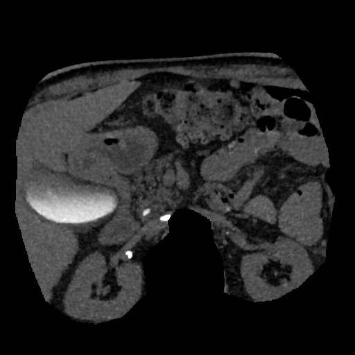 File:Normal CT intravenous cholangiogram (Radiopaedia 38199-40208 Axial IVC (MIP) 30).png