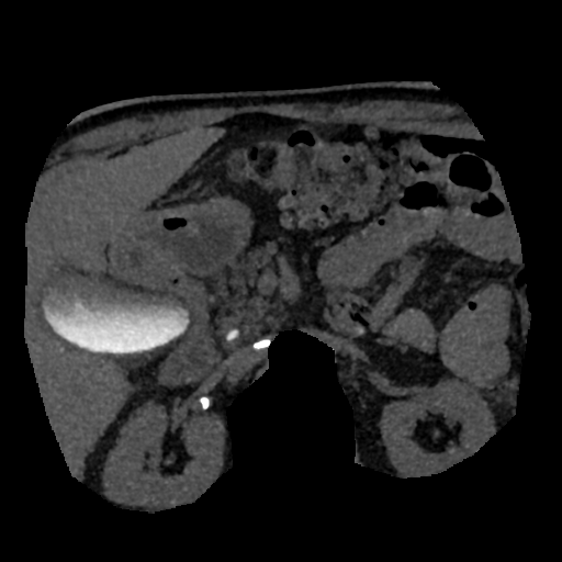 File:Normal CT intravenous cholangiogram (Radiopaedia 38199-40208 Axial IVC (MIP) 31).png