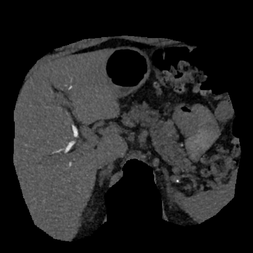 File:Normal CT intravenous cholangiogram (Radiopaedia 38199-40208 Axial IVC (MIP) 55).png