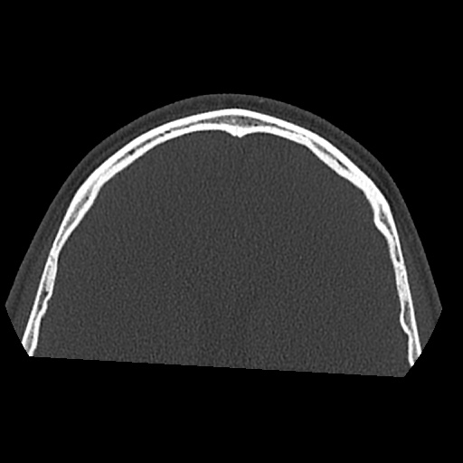 Normal CT paranasal sinuses (Radiopaedia 42286-45390 Axial bone window 6).jpg