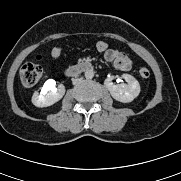 File:Normal CT split bolus study of the renal tract (Radiopaedia 48631-53634 Axial split bolus 112).jpg