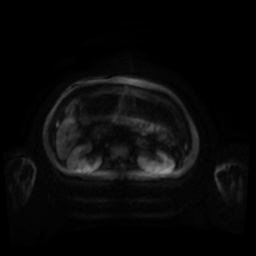 Normal MRI abdomen in pregnancy (Radiopaedia 88001-104541 Axial DWI 120).jpg