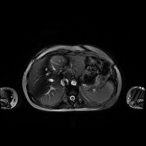 File:Normal MRI abdomen in pregnancy (Radiopaedia 88001-104541 Axial Gradient Echo 9).jpg
