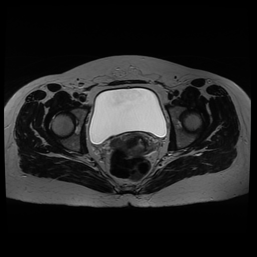 Normal MRI abdomen in pregnancy (Radiopaedia 88005-104548 Axial T2 37).jpg