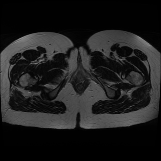 Normal MRI abdomen in pregnancy (Radiopaedia 88005-104548 Axial T2 52).jpg