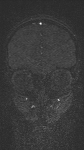 Normal MRI brain with MRV- teenager (Radiopaedia 49425-54553 Coronal MRV 67).jpg