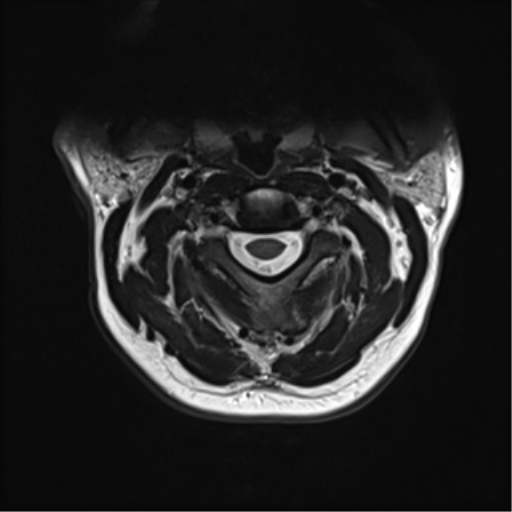 File:Normal MRI cervical spine (infection protocol) (Radiopaedia 53916-60039 Axial T2 16).png
