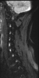 File:Normal MRI cervical spine (infection protocol) (Radiopaedia 53916-60039 Sagittal DWI 11).png