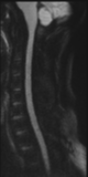 File:Normal MRI cervical spine (infection protocol) (Radiopaedia 53916-60039 Sagittal DWI 21).png
